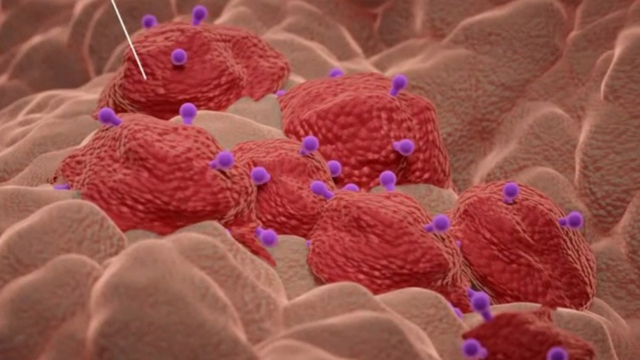 کانسر پروستات مقاوم به درمان ضد هورمون (Castration-Resistant Prostate Cancer; CRPC):